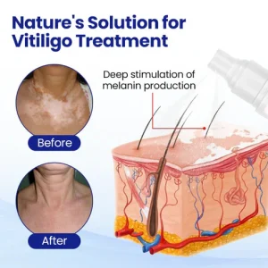 Oveallgo® Evenora Herbal Spray