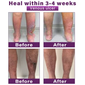 CVREOZ® Polidocanol Nano Varicose Vein Patch