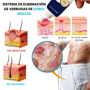 Cvreoz® removes genital warts from the root and without leaving a trace.