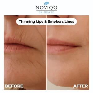 Noviqo™ – Anti-Wrinkle Freeze-Dried Nano-Silk Collagen System