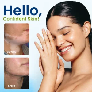 Cvreoz® Vitiligo Treatment Spray