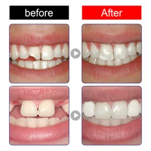 Histone™ Natural Tooth Repair Gel