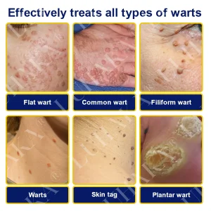 LUHAKA® SKIN TAG CRYO TREATMENT SPRAY ACE