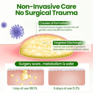 Cvreoz® KnotAway Lipoma Removal Cream