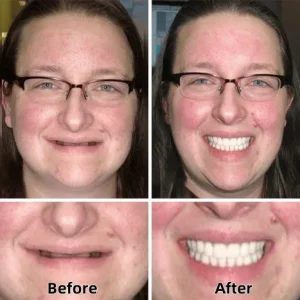 LAOZIK™-Advanced Custom-Fit Functional Dentures