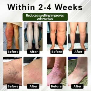 ATTDX® HormoBalance Edema Ear Patch