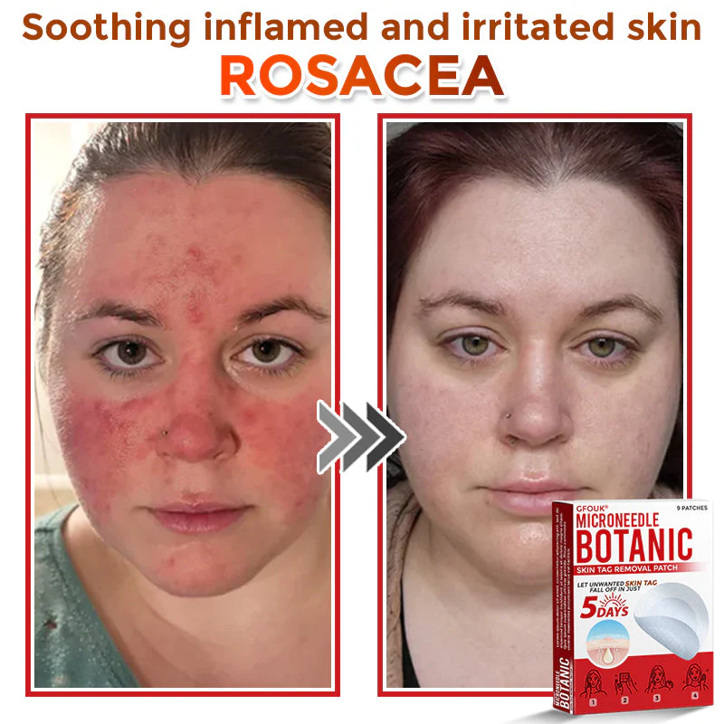 GFOUK® MicroNeedle Botanic Skin Tag Removal Patch