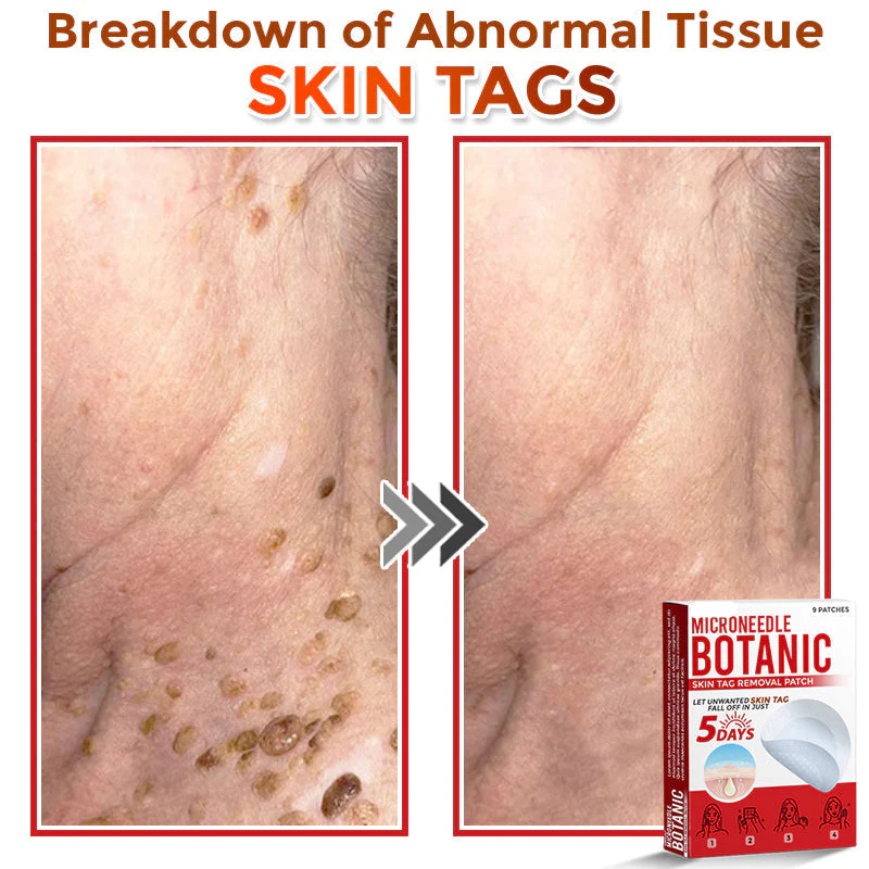 LOVILDS® MicroNeedle Botanic Skin Tag Removal Patch