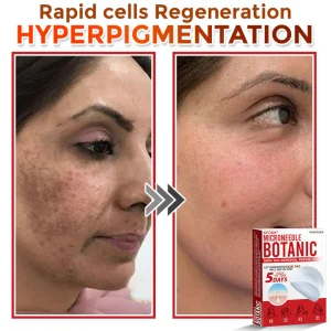 GFOUK® MicroNeedle Botanic Skin Tag Removal Patch