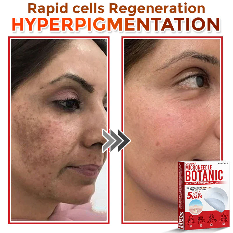 GFOUK® MicroNeedle Botanic Skin Tag Removal Patch