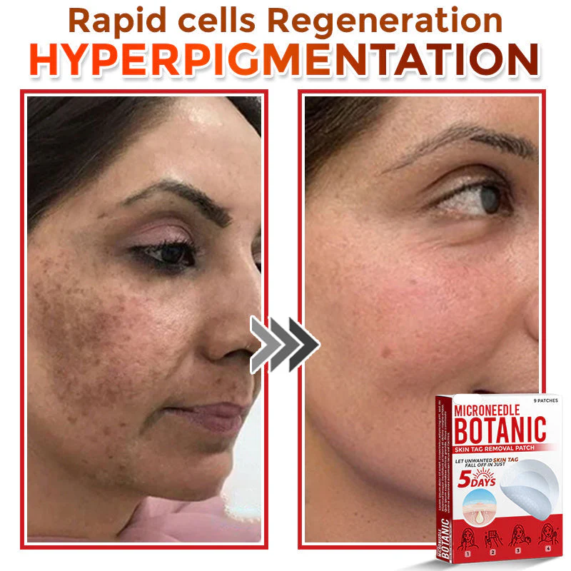 LOVILDS® MicroNeedle Botanic Skin Tag Removal Patch