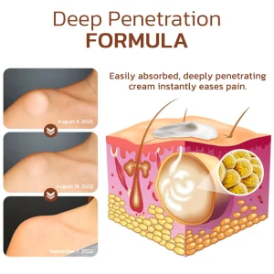 Cvreoz® Lumpless Lipoma Treatment Cream