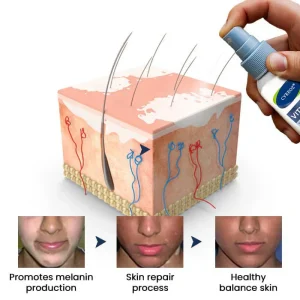 Cvreoz® Vitiligo Treatment Spray