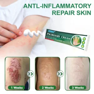 Cvreoz® Knotaway Psoriasis Cream
