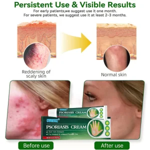 Cvreoz® Knotaway Psoriasis Cream