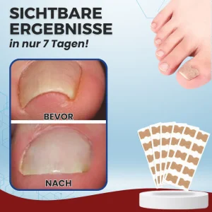 AEXZR™ Paronychia Correction Patch