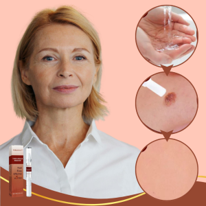 DermaLift™ Pen | Removes warts and age spots