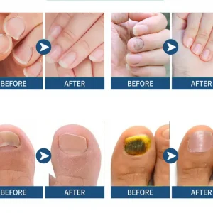 Health Care Patches – Repair and Strengthen Weak Nails