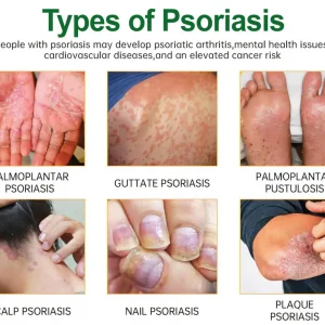 Cvreoz® Knotaway Psoriasis Cream
