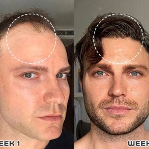 Put an end to hair loss with LOVILDS™ Rollerball Serum