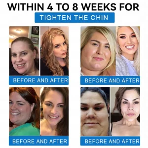 ADFIRE® SMGT-GLP-1 Tirzepatide & Collagen Nano Microneedle Weight Loss Patch