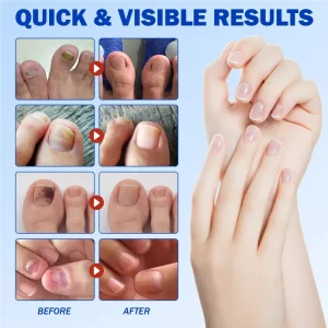 Health Care Patches – Repair and Strengthen Weak Nails