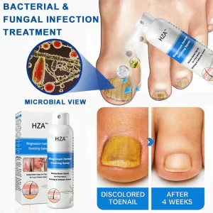 HZA™ Magnesium Herbal Psoriasis Spray