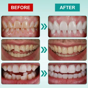 Ourlyard® Instant Stick on Dental Veneers