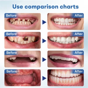 Nurbini® ThermoSeal Fresh Denture