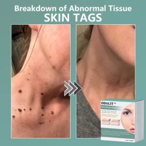 ODALIT™ MicroNeedle Botanic skin Tag Removal Patch