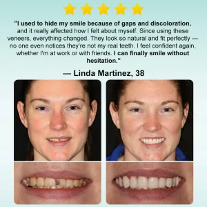 Ourlyard® Instant Stick on Dental Veneers