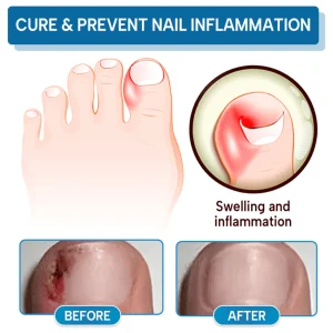 Lyyeto® OnyxiGuard Fungal Repair Herbal Spray ACE