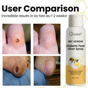 Croaie® Bee Venom Diabetic Foot Ulcer Spray