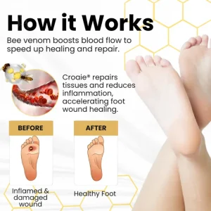 Croaie® Bee Venom Diabetic Foot Ulcer Spray