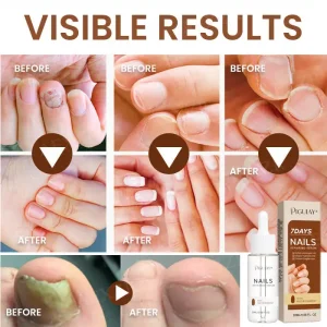 Piguiay® Nails Repairing Serum