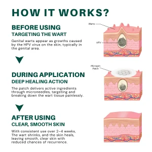 ODALIT™ Genital Wart Removal Patch