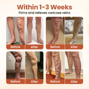 CVREOZ® VeinTarget Nanotech Microneedle Patch