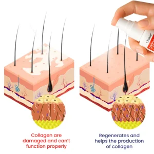 Croaie® Vitiligo Treatment Spray - No allergies