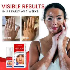 Croaie® Vitiligo Treatment Spray - No allergies