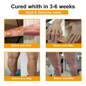 Yagoo™ Botulinum & Bee Essence Pain Relief Bone Healing Cream