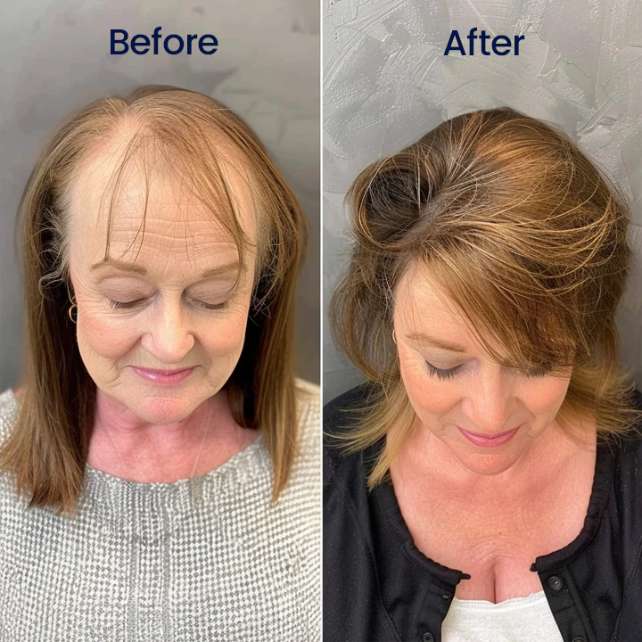 Biancat® Maximum Strength 5% Minoxidil Fast-Action Hair Growth Serum 5 Biancat® Maximum Strength 5% Minoxidil Fast-Action Hair Growth Serum