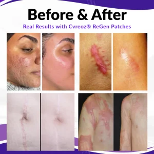 Cvreoz® ReGen Microneedles Pro Patches with Hyaluronic Acid Nano
