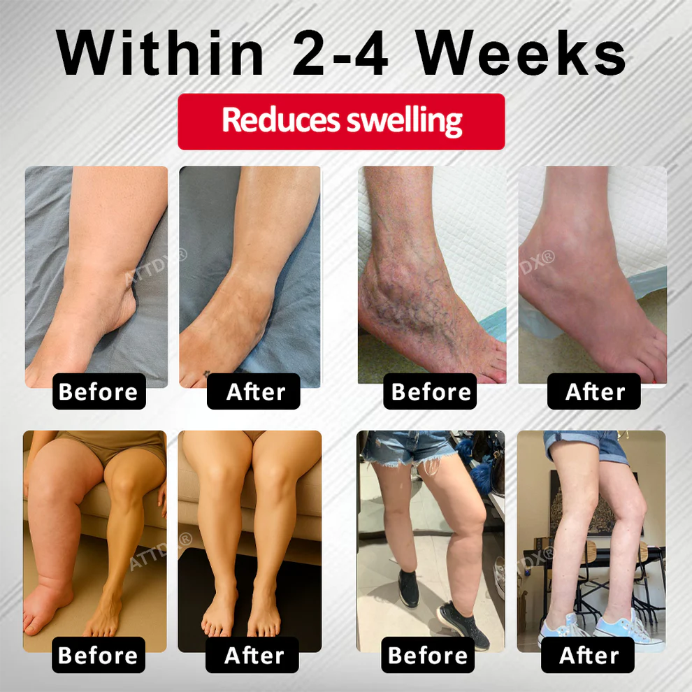ATTDX® Advanced CVI Edema Therapy Cream 2 ATTDX® Advanced CVI Edema Therapy Cream
