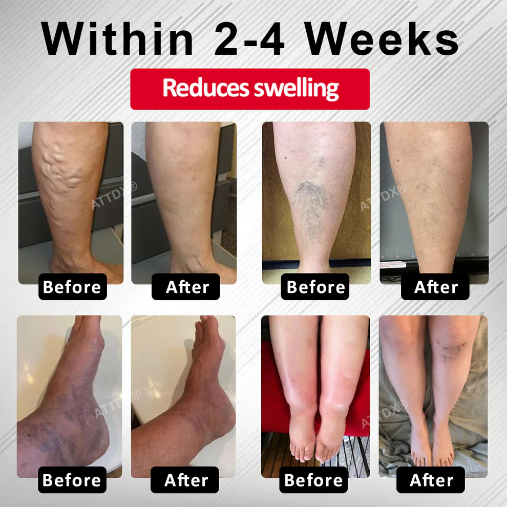 ATTDX® Advanced CVI Edema Therapy Cream 3 ATTDX® Advanced CVI Edema Therapy Cream