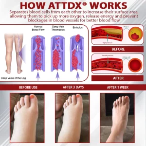 ATTDX® Advanced CVI Edema Therapy Cream 15 ATTDX® Advanced CVI Edema Therapy Cream
