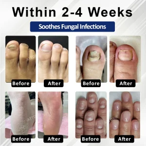 ATTDX® FungaGuard Botanica Roll On Stick