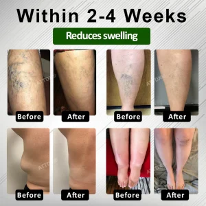 ATTDX® HerbalDrain Edema Comfort Massage Cream