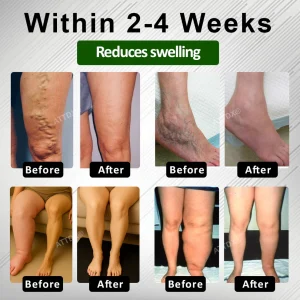 ATTDX® HerbalDrain Edema Comfort Massage Cream