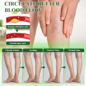 Oveallgo® VeinoRoll Therapy Edema Comfort Cream