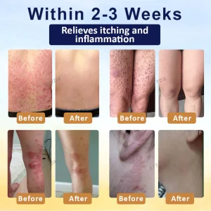 Cvreoz® PsoriasisCare Mellifera Venom Skin Healing Spray